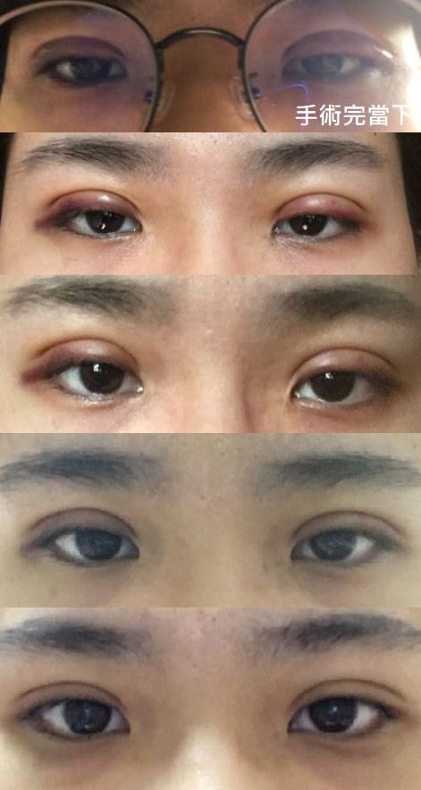 後悔沒早點做的醫美 × 新彩整形外科診所 ♥ 縫雙眼皮六年經