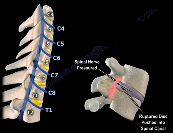 Neck Pain, Cervical Disc Herniation, & Cervical Radiculopathy | by Nabil  Ebraheim | Medium