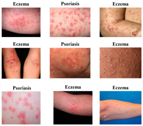 Beyond the Surface A Comprehensive Guide to Eczema, Psoriasis, and