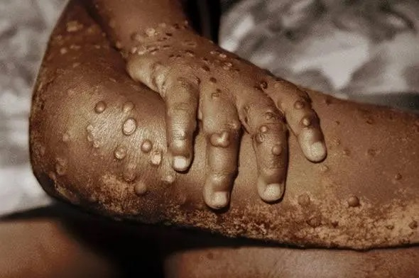 Mpox in Ghana Has Entered a Dangerous Phase