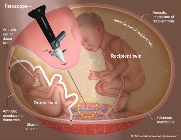 Twin Pregnancy: Fragile Hope & Unimaginable Loss