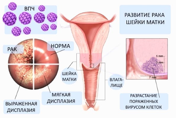 впч 52 типа что делать