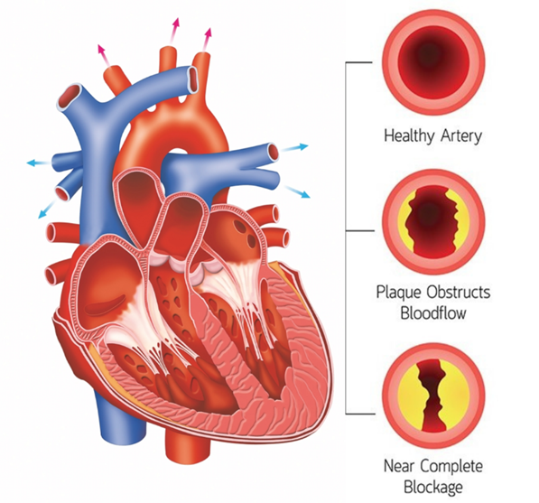 ISCHEMIC HEART DISEASE IHD INTRODUCTION By Ozmedsonline Medium ischemic-heart-disease-ihd-introduction-by-ozmedsonline-medium