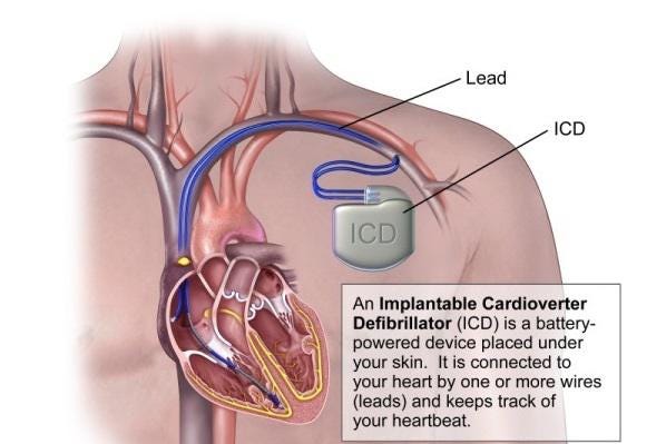 Cardiac Resynchronization Therapy (CRT) - Patient9 - Medium