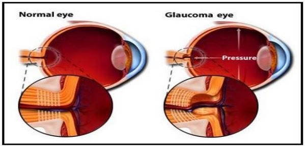 Genetics of primary congenital glaucoma