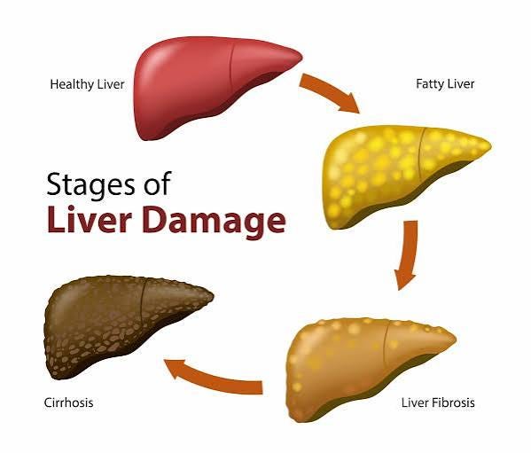 What Causes Fatty Liver Disease? Common Causes, Risk Factors, and What You Can Do