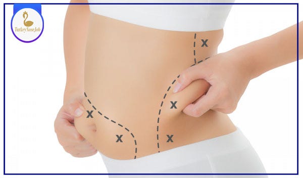 Five Things You Need to Know About Stomach Liposuction - Houston Lipo Center