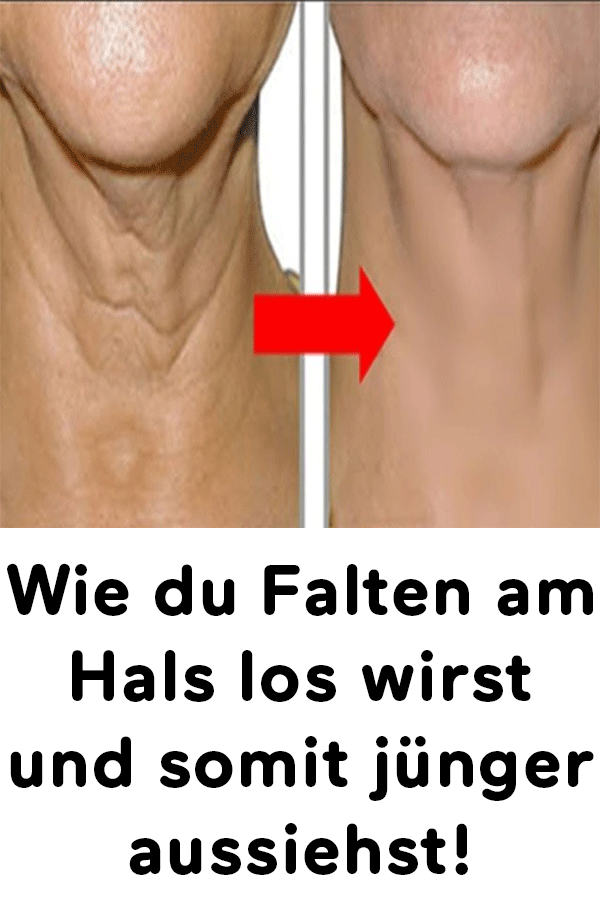 Falten Am Hals Schilddrüse