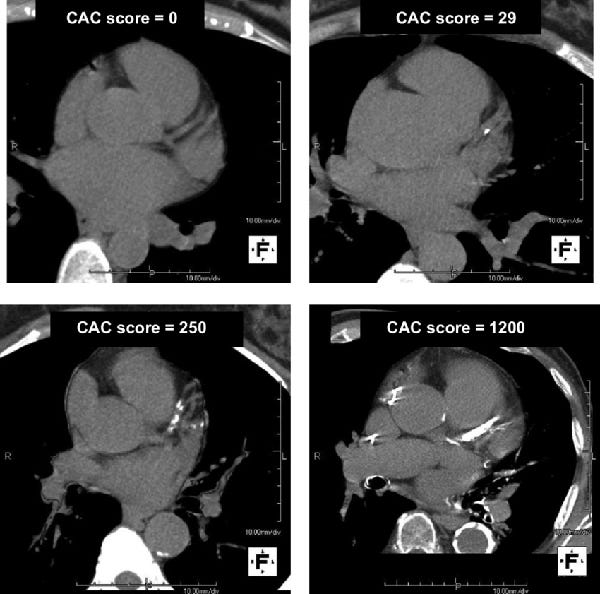 Coronary artery calcium scoring — Is it useful? by Dr Ross Walker