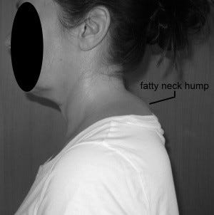 forward head posture neck hump