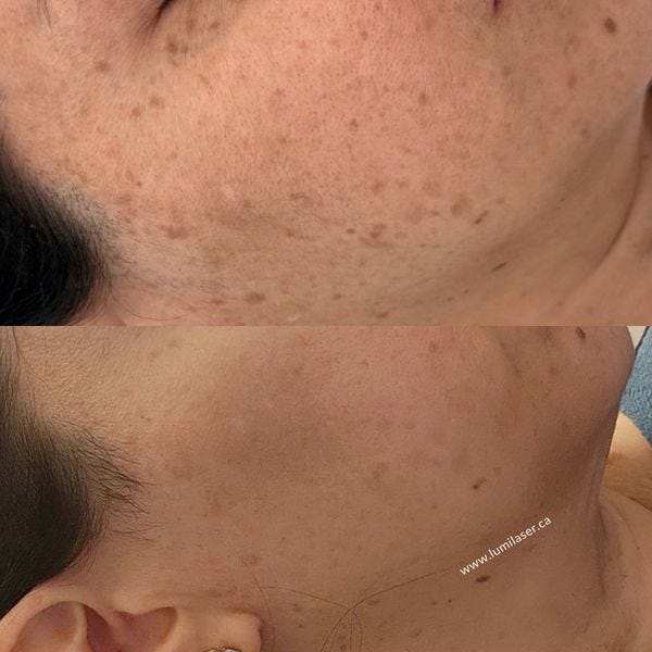 https://www.lumilaser.ca/laser-dark-spot-removal.html