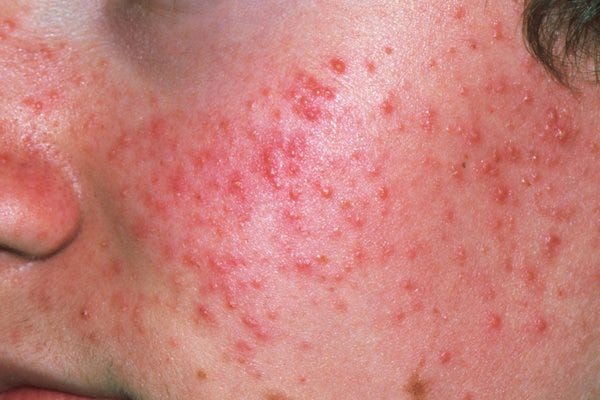 7 Best Acne Products For Teenagers: Fight Your Teenage Acne Woes