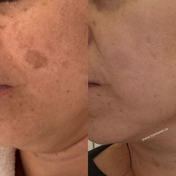 https://www.lumilaser.ca/laser-dark-spot-removal.html