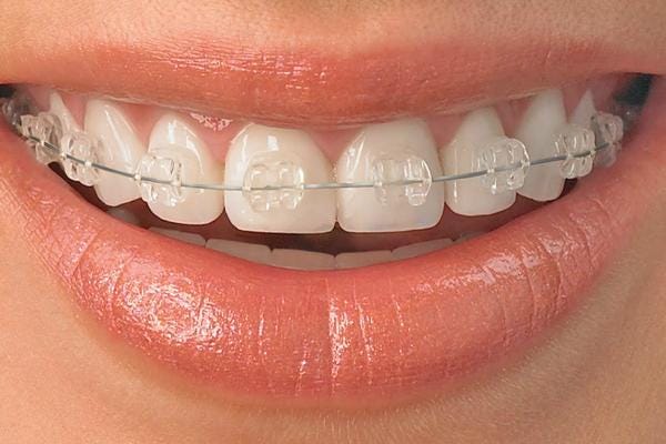 How Ceramic Braces Can Transform Your Smile, by Northenden House