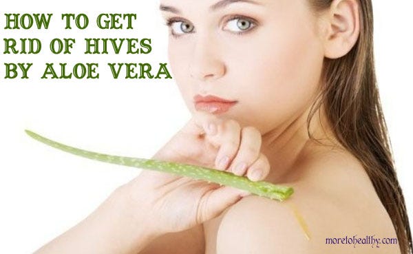 How You Can Eliminate Hives?. How You Can Eliminate Hives? 