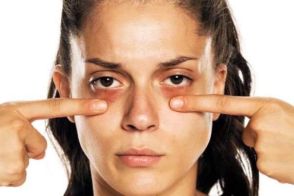 eye-bags-types-causes-treatment-premier-clinic