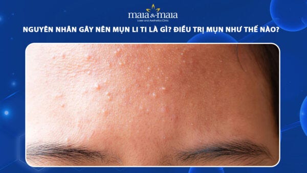 Nguyên nhân gây nên mụn li ti là gì? Điều trị như thế nào?