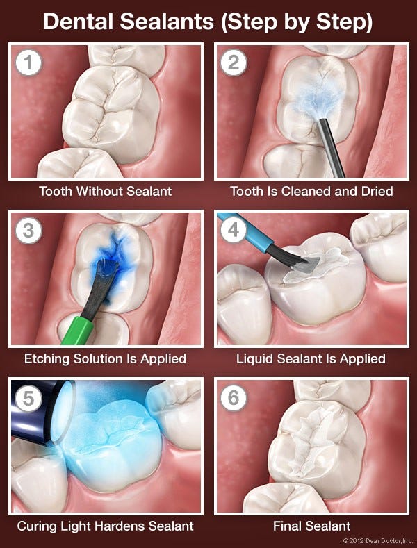 How Long Do Kids Sealants Take To Put On: Chair Time Decoded