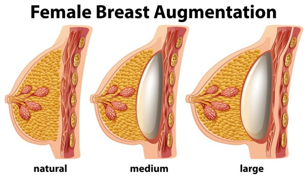 Breast Augmentation. Breast augmentation is a surgical…, by Patient9