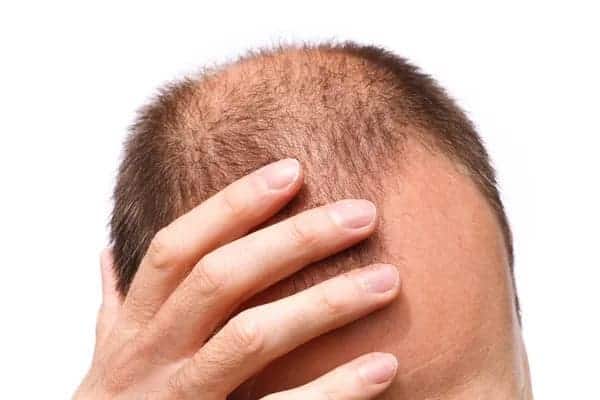 Why Some People Go Bald While Others Don’t — The Genetic Mystery