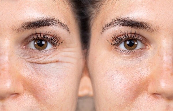 Are You Making These Mistakes? Causes of Eye Wrinkles Revealed!