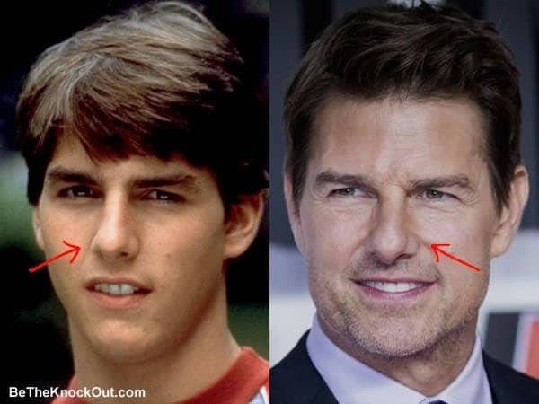 What kind of plastic surgery did Tom Cruise have? | by Nakamura | Oct, 2023  | Medium