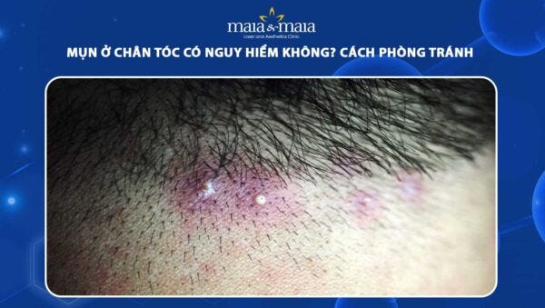 Mụn Ở Chân Tóc Có Nguy Hiểm Không? Cách Điều Trị & Phòng Ngừa