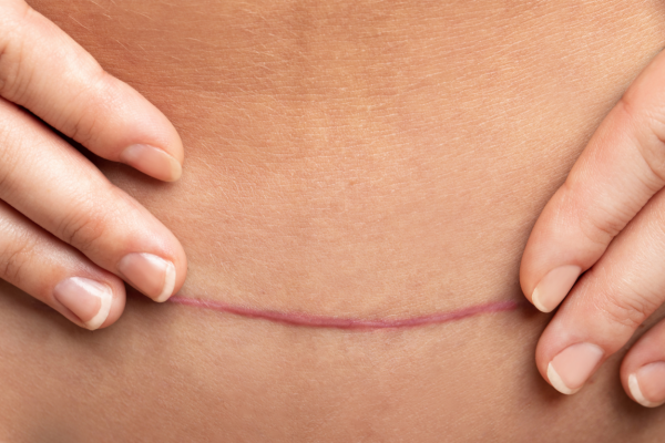 How to Get Rid of Scars After Tummy Tuck, by Alyson Ellis