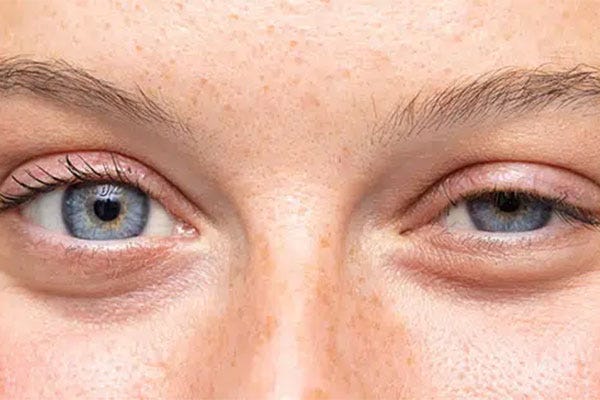 How to fix drooping eyelids after Botox? | by best clinic | Medium