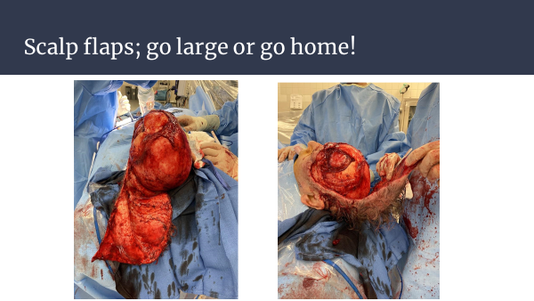 Dr. Joel Aronowitz — Scalp flaps; go large or go home!