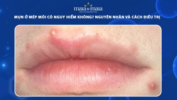 Mụn ở mép môi có nguy hiểm không? Nguyên nhân và cách điều trị
