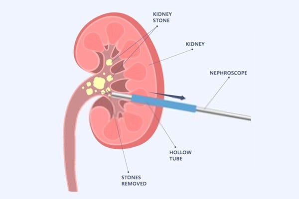 Percutaneous Nephrolithotomy (PCNL) | by Dr. Naresh Kumar Garg | Jun ...