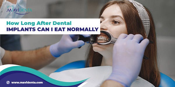 Exquisite How Long After Dental Implants Can I Eat Normally Image Photography Exquisite How Long After Dental Implants Can I Eat Normally Image Photography