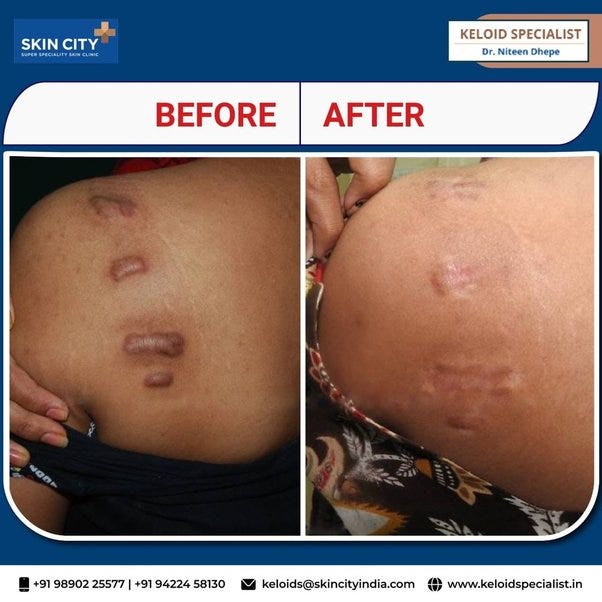 Dr. Niteen Dhepe, a keloid specialist in Pune, provides a wide range of keloid scar removal