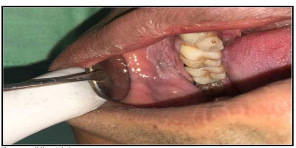Factors associated with snuff dipper’s lesion among snuff users in Peshawar, Pakistan