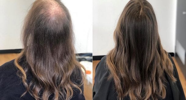 Hair Fall Treatment Dubai: Understanding Hair Shedding and Finding the Right Solution