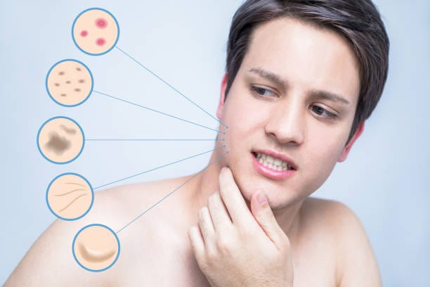 Say Goodbye to Acne: The Comprehensive Guide and Revamin Acne Cream  by HEALTH TREE  Medium