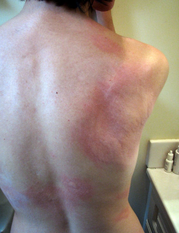 I Got Full Body Hives From Fabric Softener Sheets by Teresa Trimm