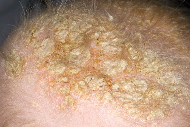 I Cured Seborrheic Dermatitis/Cradle Cap | ILLUMINATION-Curated