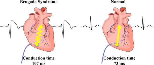 Brugada Syndrome