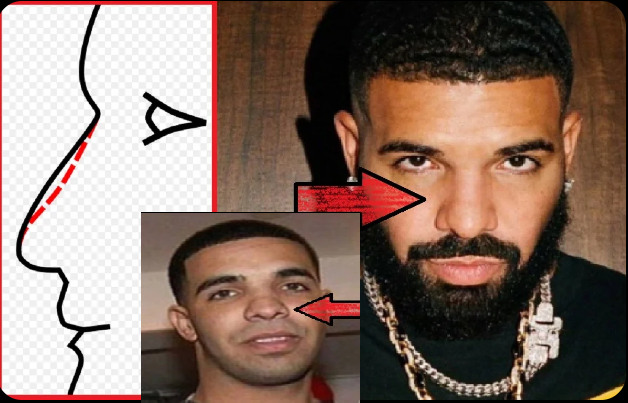 Is Drake Nose Job Rhinoplasty Surgery True? - Famelord - Medium