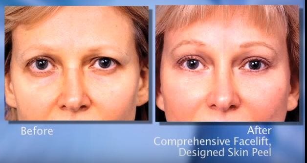 Botched facelift 2024