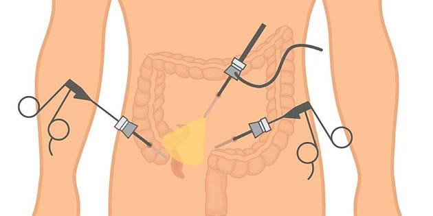 Appendix Surgeon