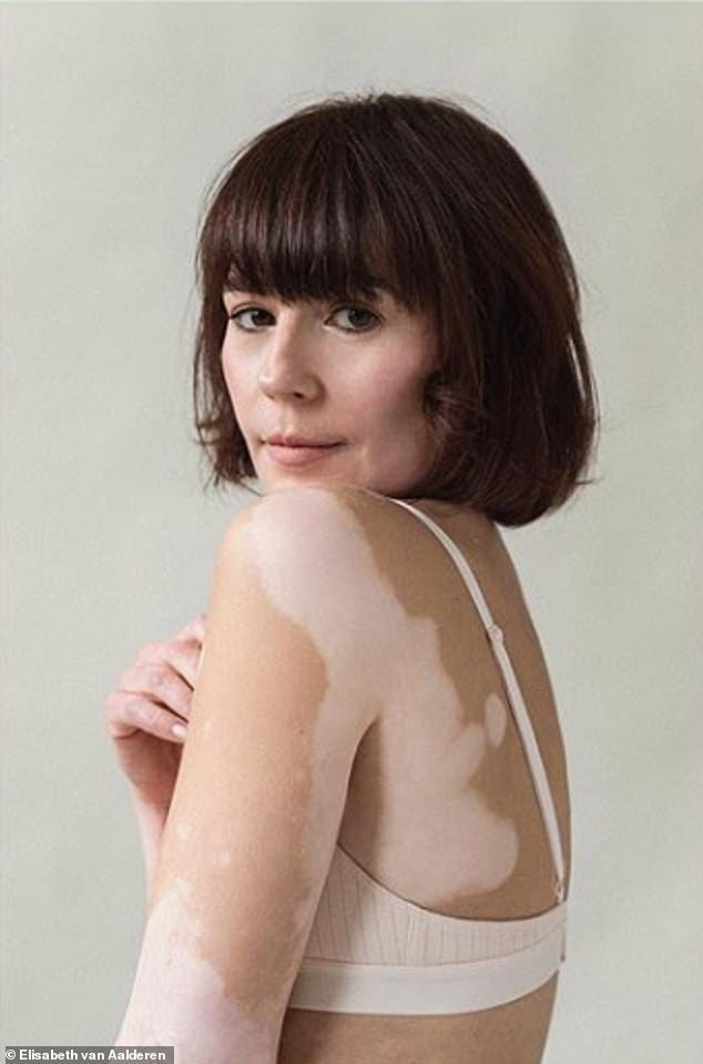 Kenali Gejala dan Penanganan Penyakit Vitiligo