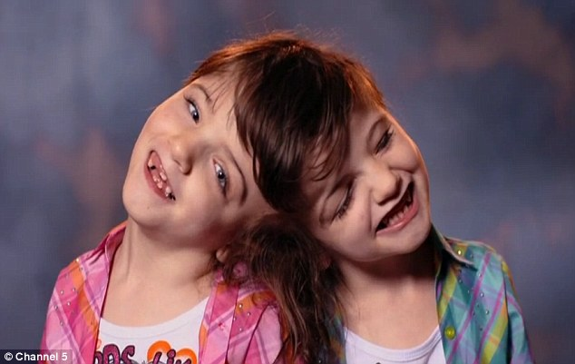 Craniopagus Twins. 11–29–16, Adil | by Five Guys | Five Guys Facts | Medium