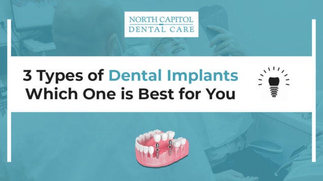 3 Types of Dental Implants Which One Is Best for You — North Capitol ...