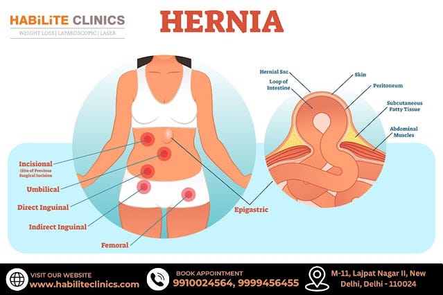 Hernia: Symptoms, Causes, Types, Treatment | by Habilite Clinics | Jun ...