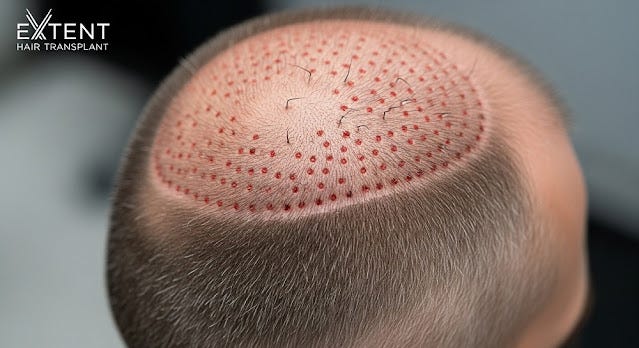 FUE Hair Replacement Advanced Permanent Solution for Natural Hair Restoration