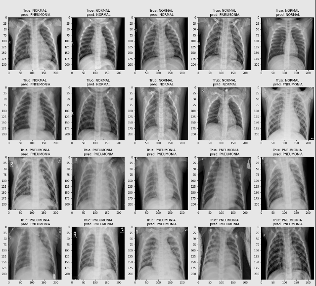 Detecting Pneumonia From Chest X-Rays Using Tensorflow and Keras with ...