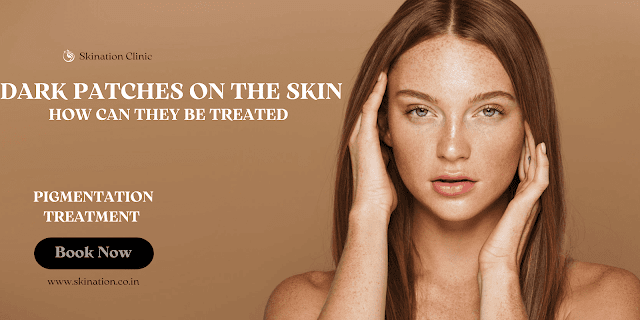 Dark spots on the skin: Causes, treatments, and remedies